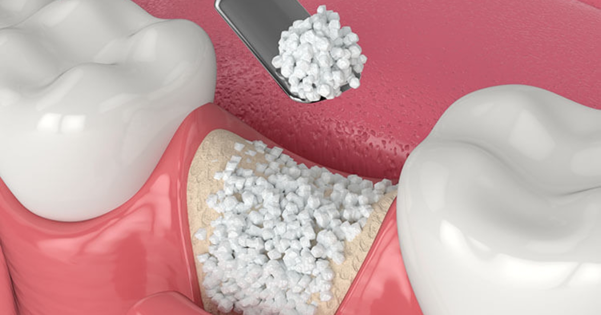 Featured image for “Pro Tips For Successful Bone Grafting: Expert Insights Revealed”