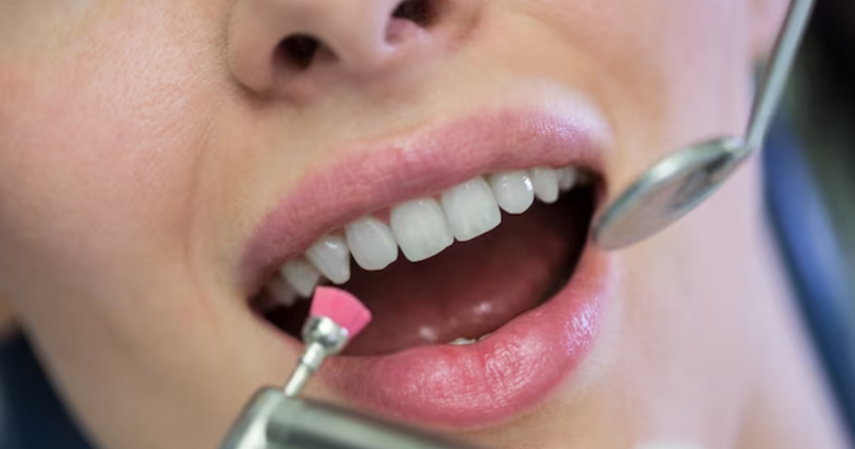 Featured image for “The Complete Guide To Fluoride Treatment For Stronger Teeth”