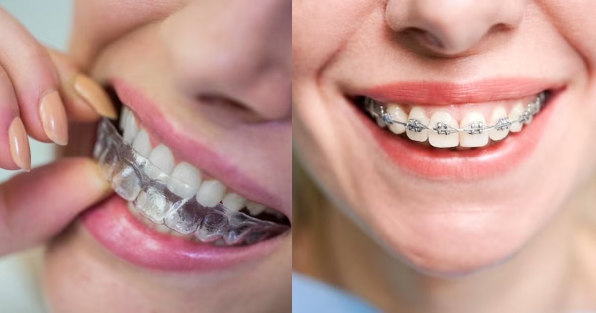 Featured image for “Achieving a Perfect Smile: Choosing Between Invisalign and Braces”