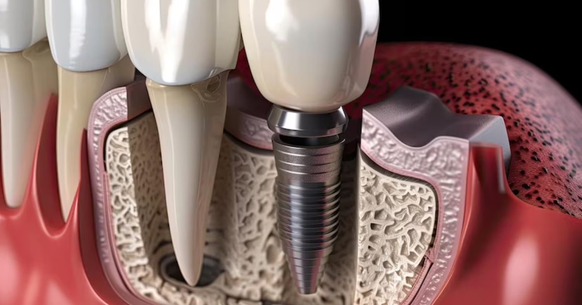 Featured image for “Transforming Smiles: The Impact of Dental Implant Restoration in Cypress”