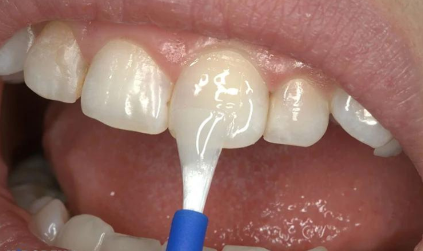 Featured image for “Fluoride Treatment: Unveiling its Role in Reversing Dental Cavities”