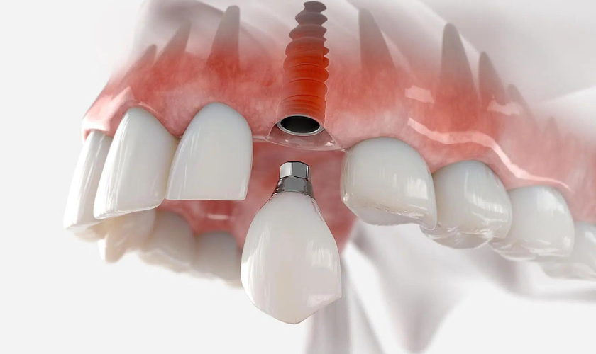 Featured image for “Unveiling the Causes and Consequences of Dental Implant Breakage”