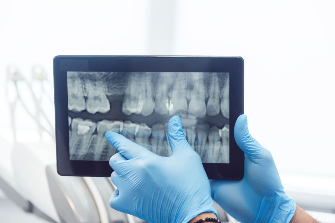 Digital Dental X-Ray in Cypress, TX - Dentist Tree