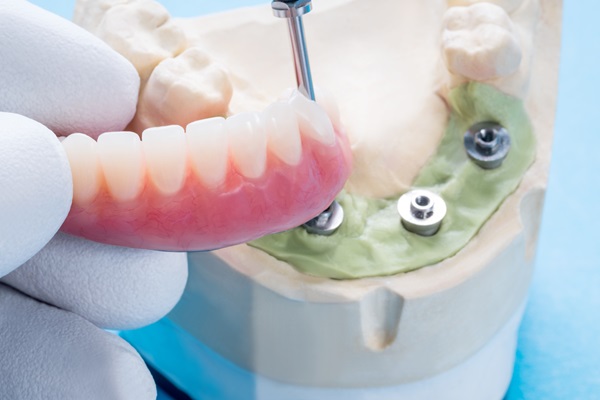 All On   Dental Implants: A Permanent Fix For Missing Teeth